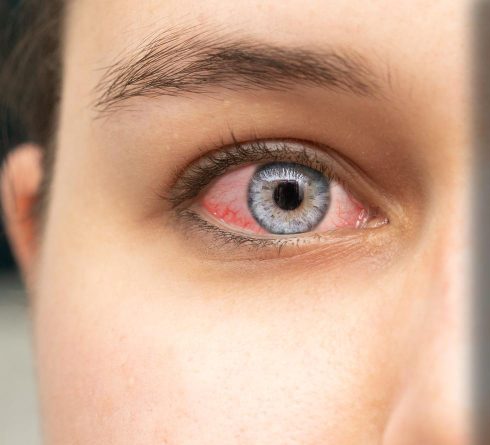 Blepharitis
