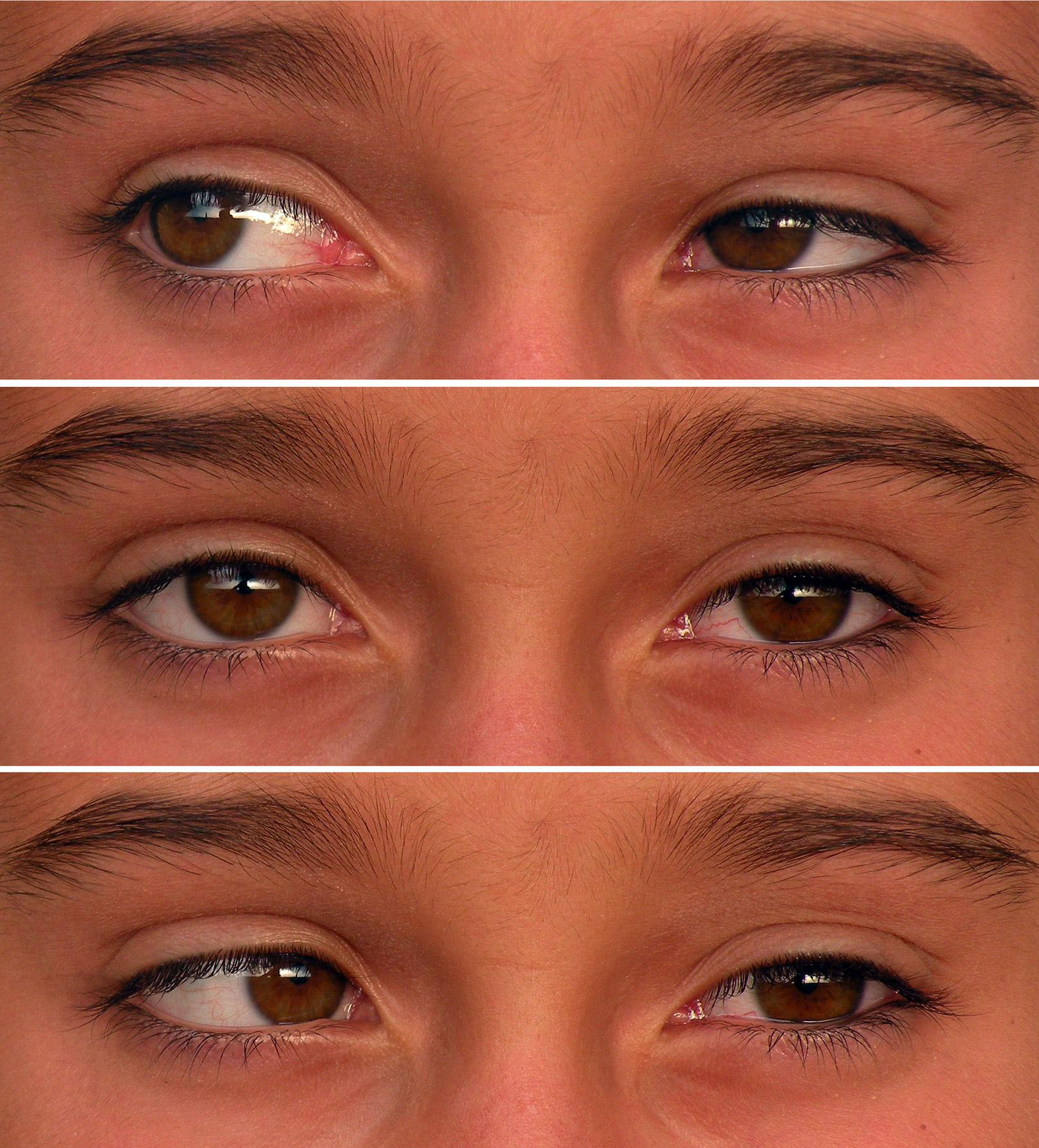 Strabismus